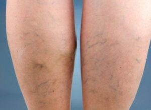 spider and varicose veins maryland