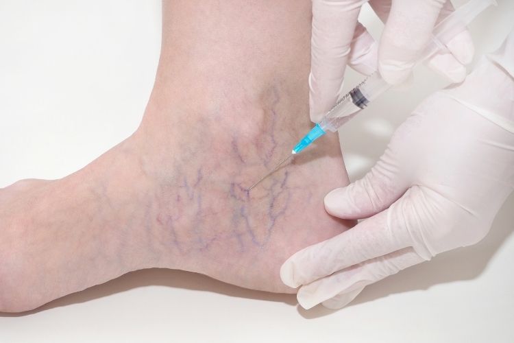 vein treatments cost maryland