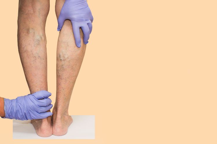 burst varicose vein ellicott city