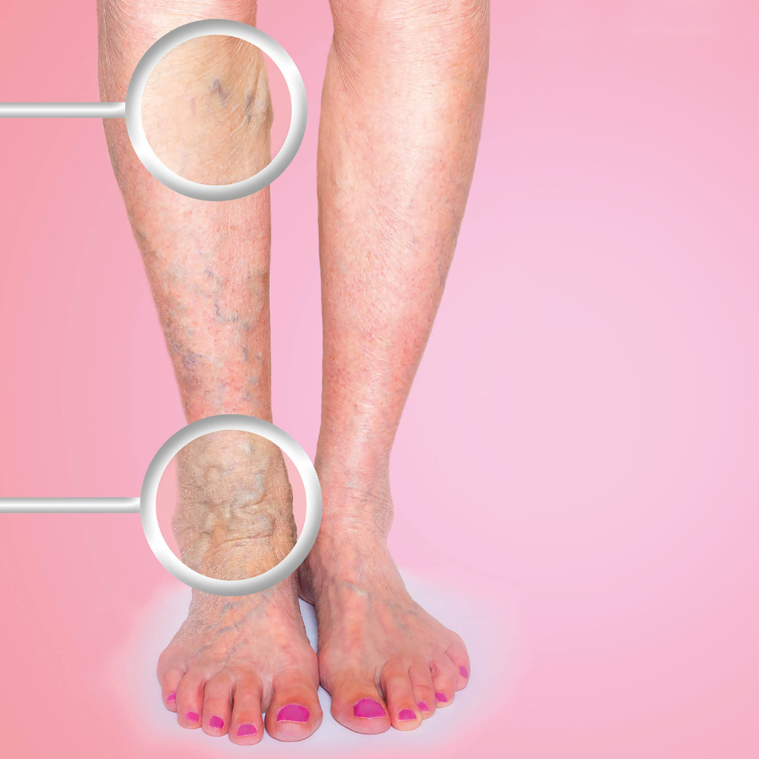 how to fix varicose veins