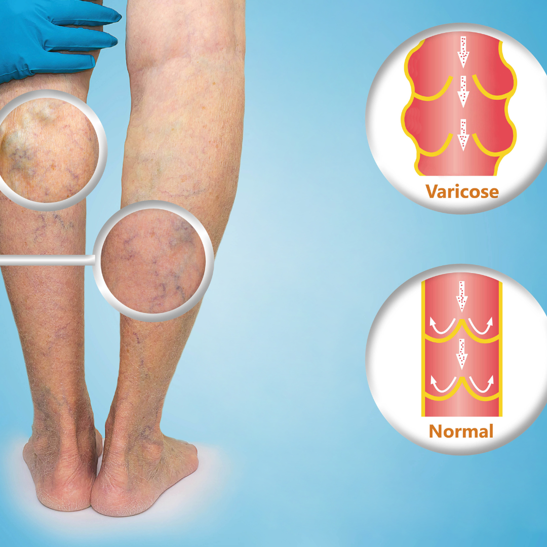 varicose vein treatments in Maryland