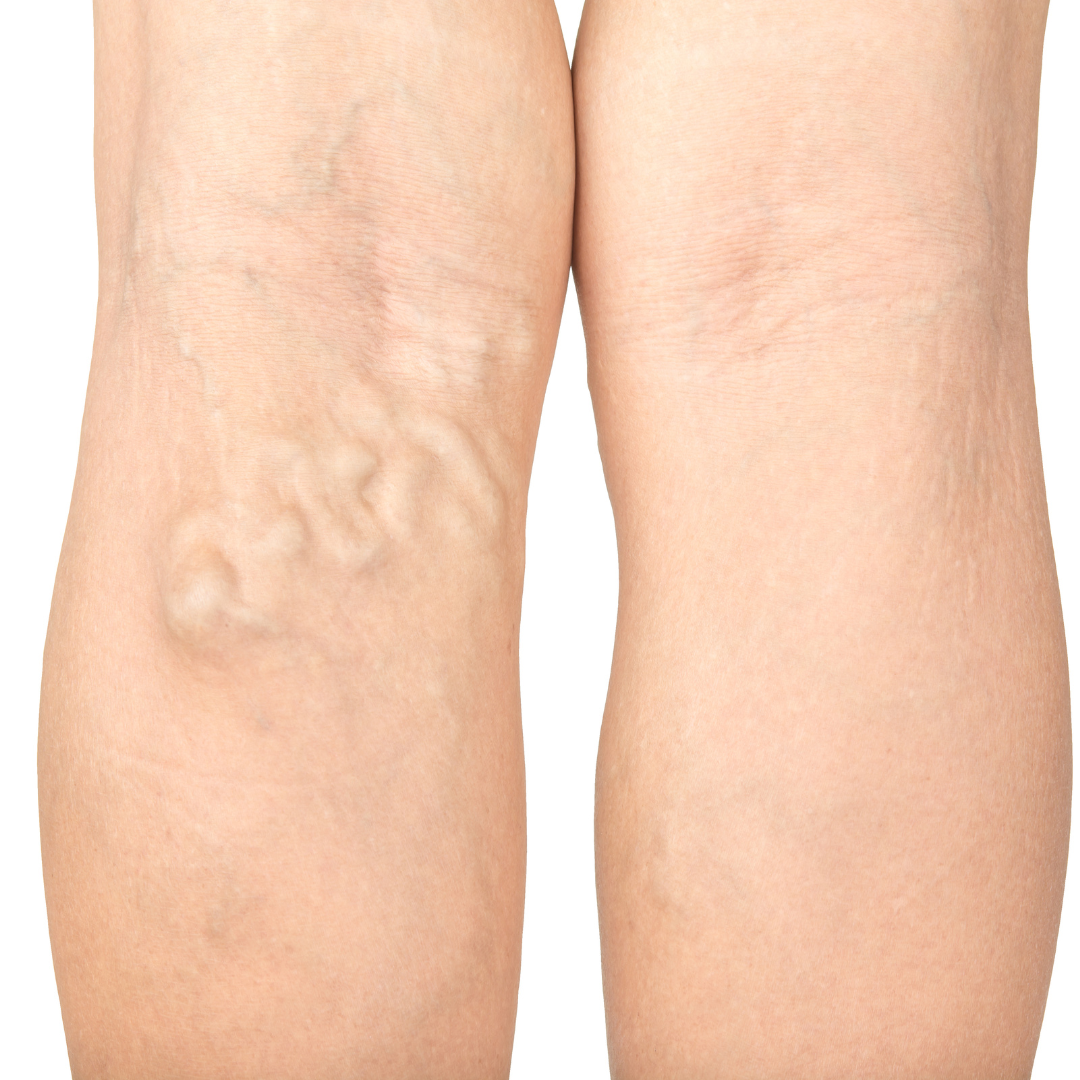 Symptoms Of Varicose Veins Maryland The Vein Center Of Maryland