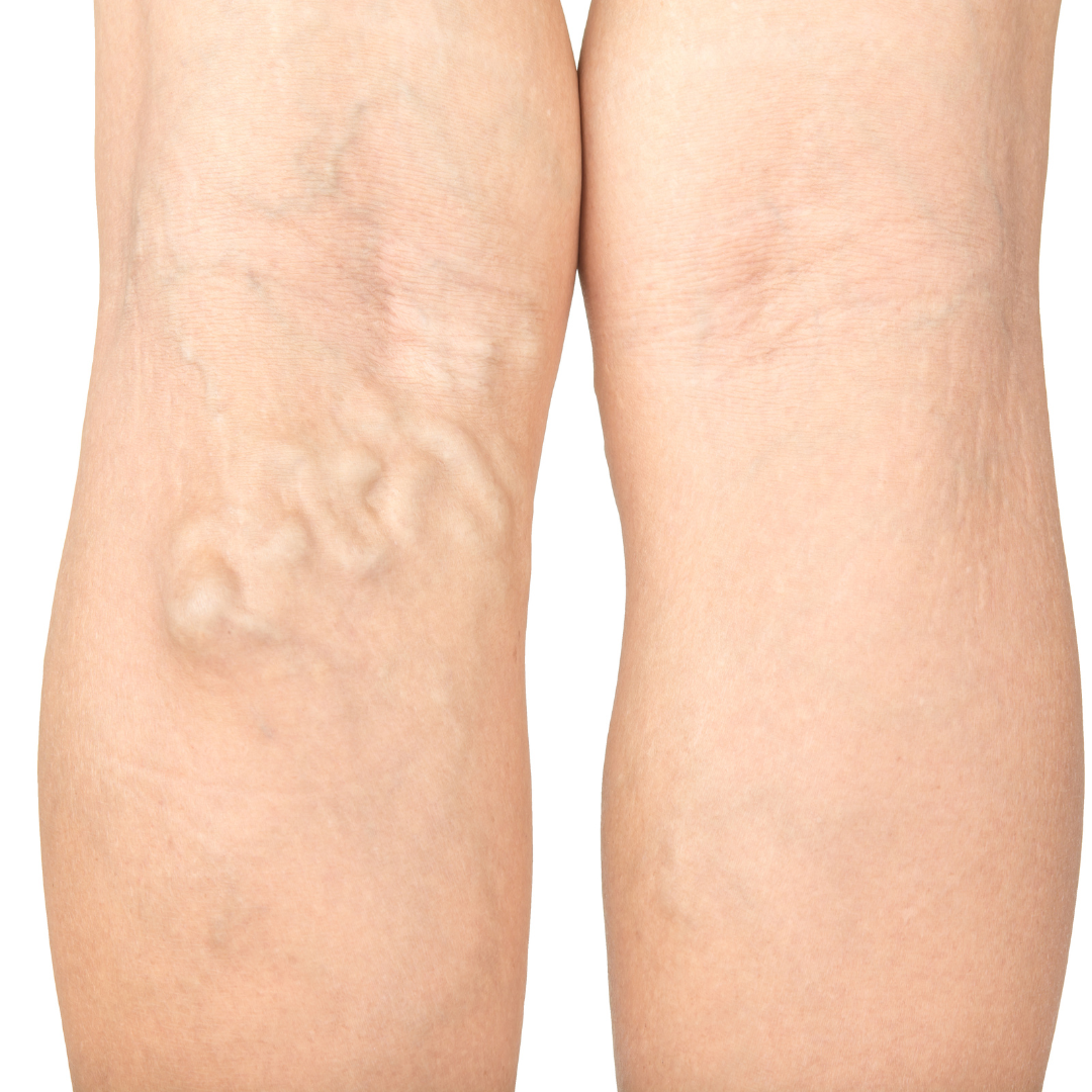 varicose veins maryland