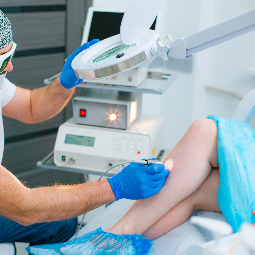 Laser Vein Treatment Maryland