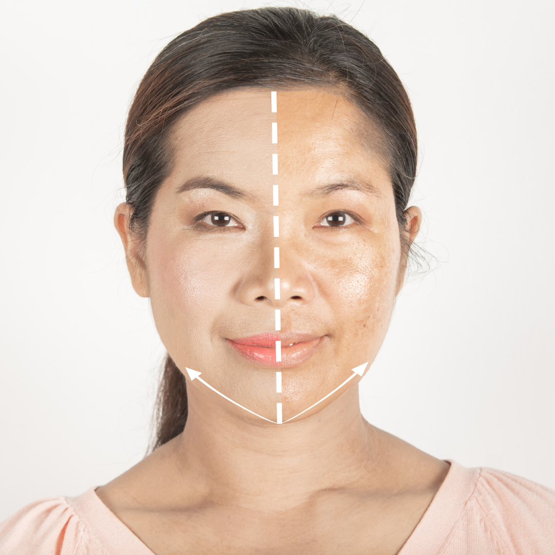 Treatment For Age Spots Maryland The Vein Center Of Maryland