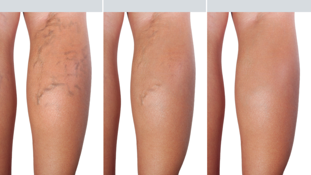 Spider and Varicose Veins Treatments: Sclerotherapy FAQs
