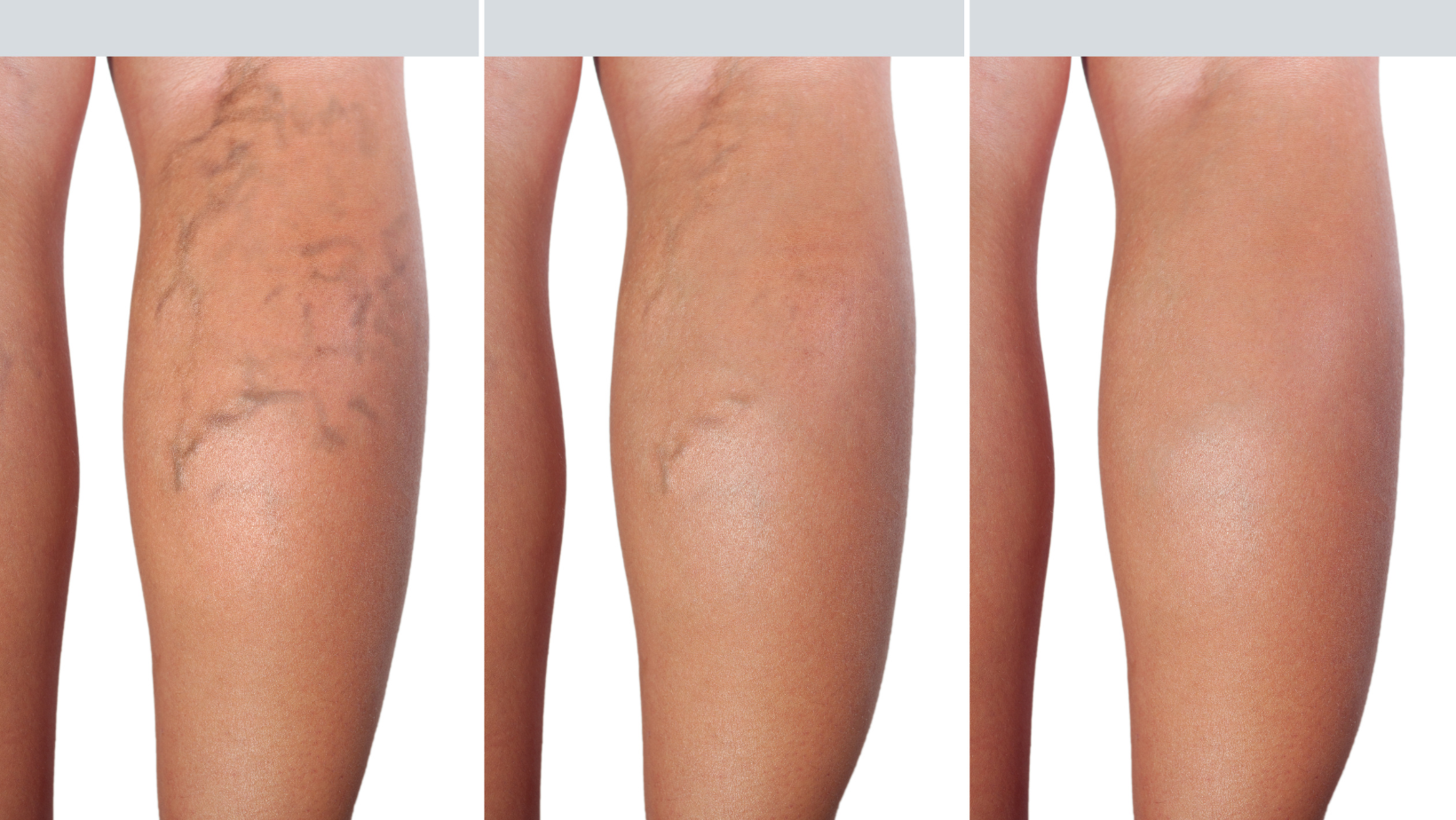 sclerotherapy montgomery county