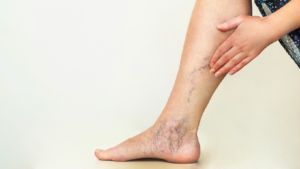 sclerotherapy montgomery county