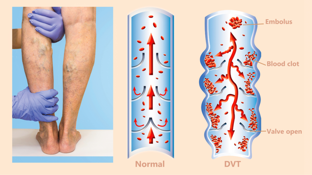 DVT Guide  Understanding Deep Vein Thrombosis - The Vein Center