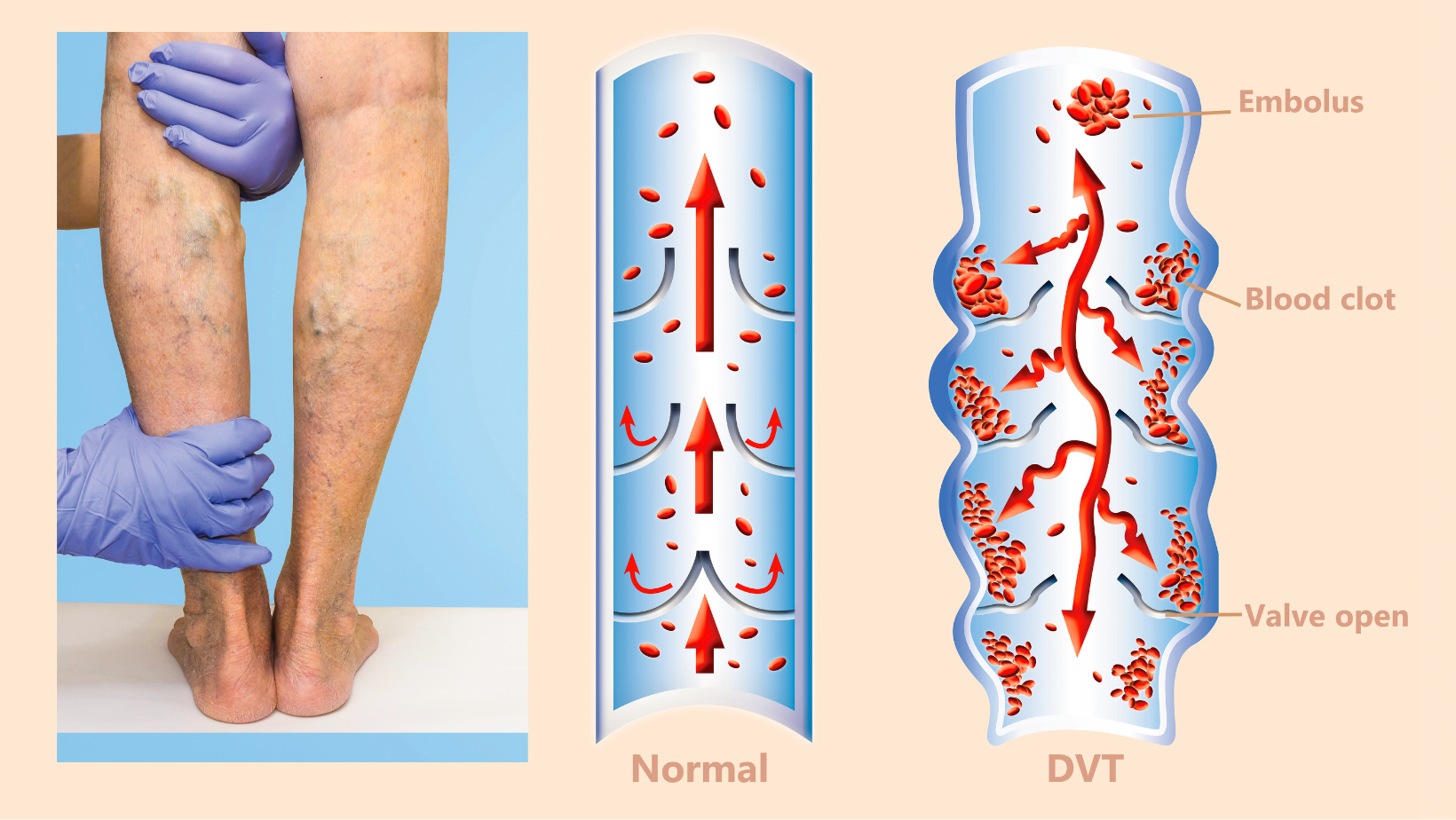 deep vein thrombosis Maryland