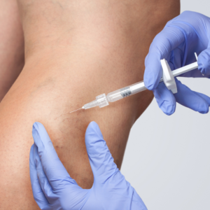 sclerotherapy for chronic venous insufficiency
