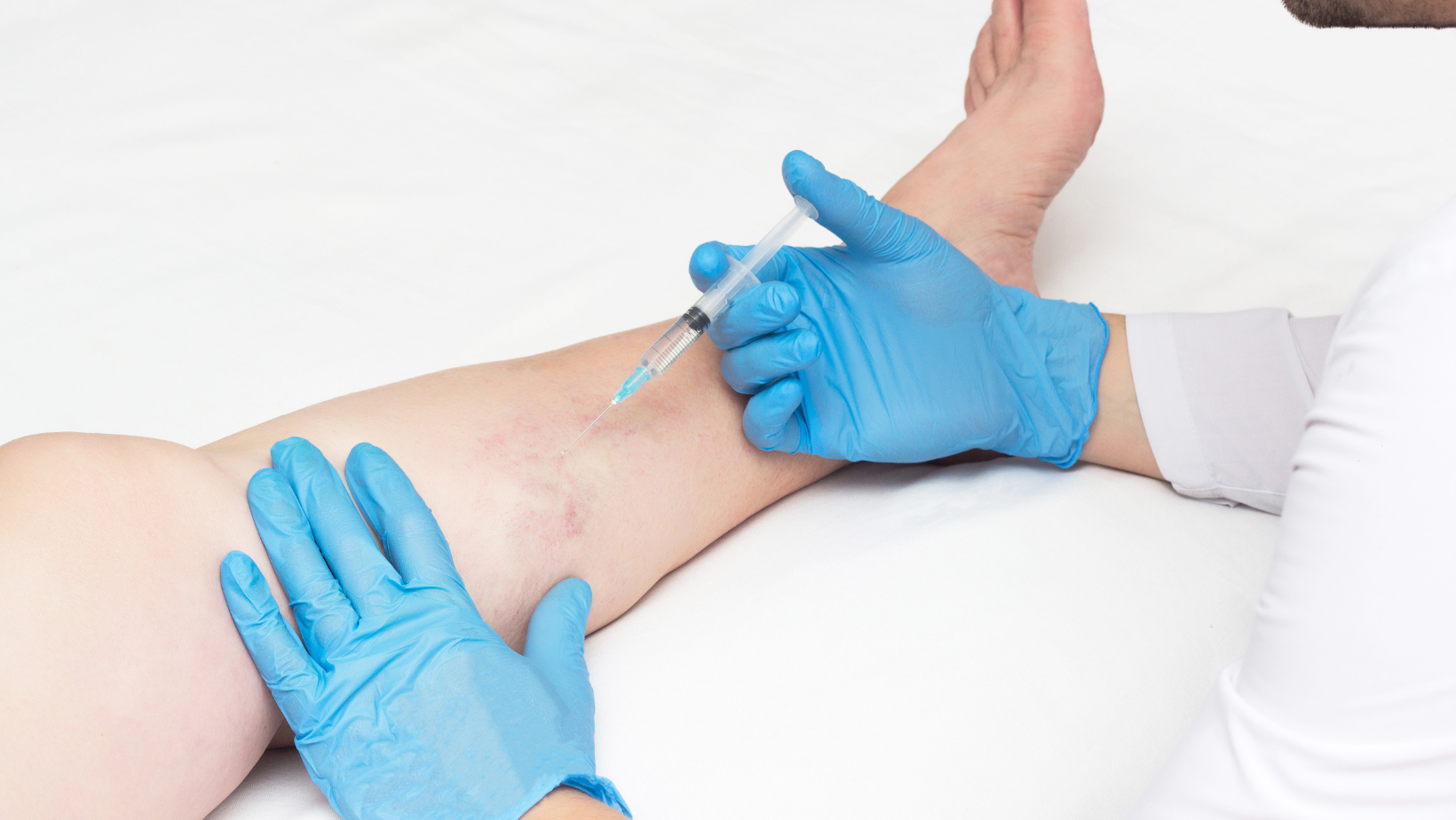 cost of sclerotherapy in Maryland