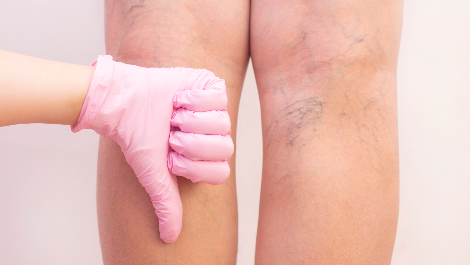 varicose vein specialist in Edgewater