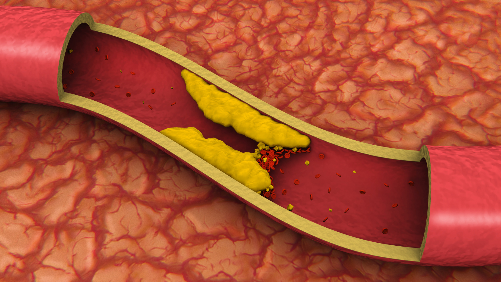 peripheral arterial disease