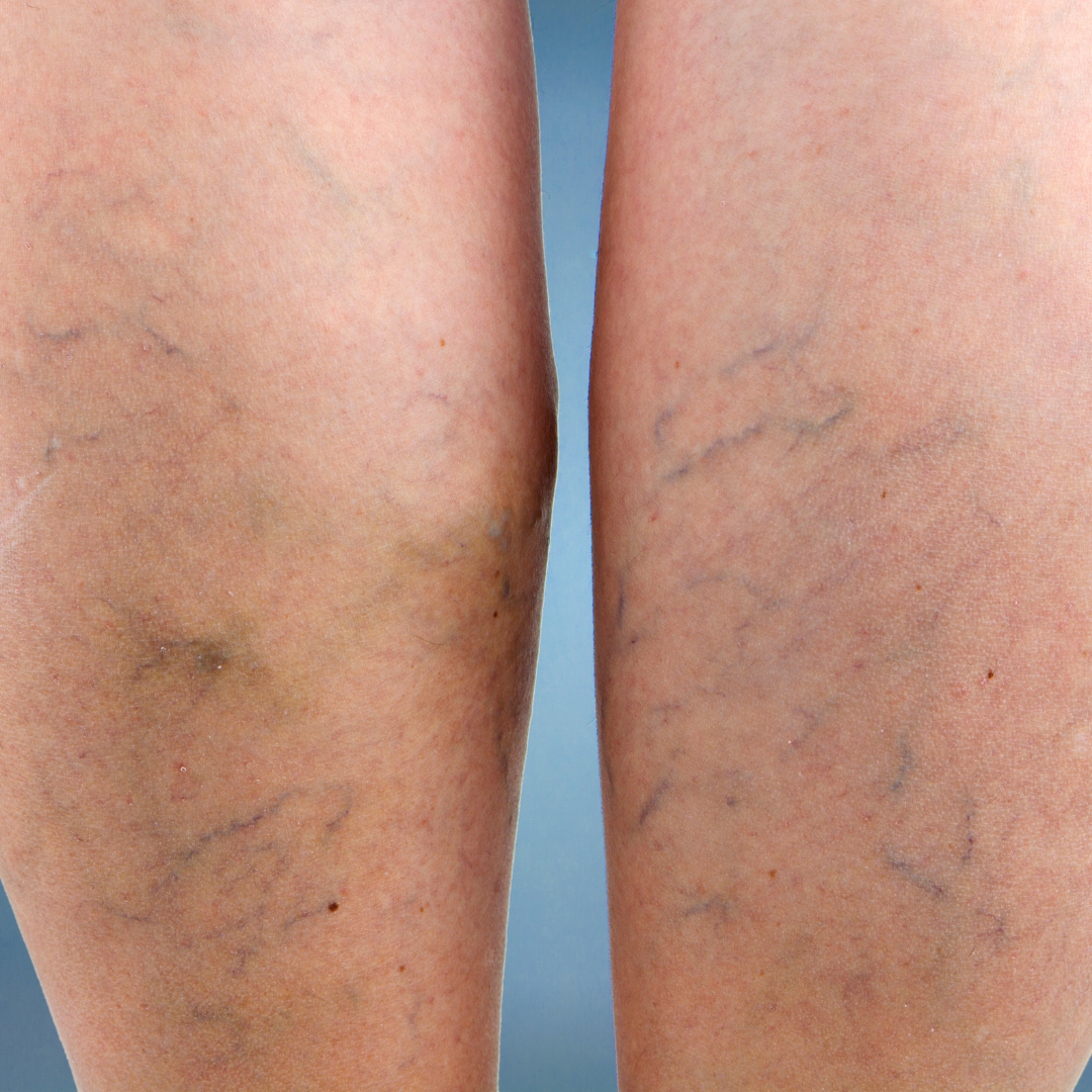 What Causes Bulging Leg Veins The Vein Center Of Maryland