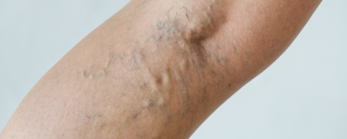 Benefits of Sclerotherapy Bel Air