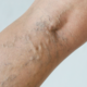 Benefits of Sclerotherapy Bel Air