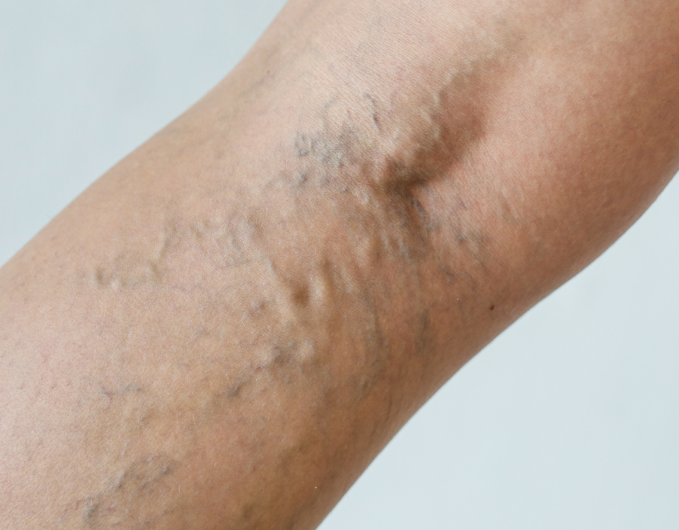 Benefits of Sclerotherapy Bel Air