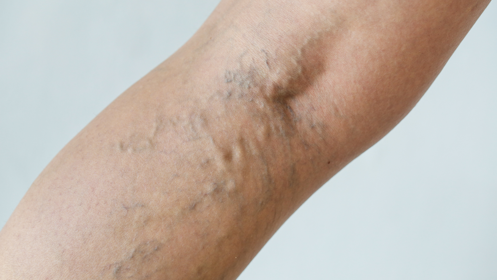 Benefits of Sclerotherapy Bel Air