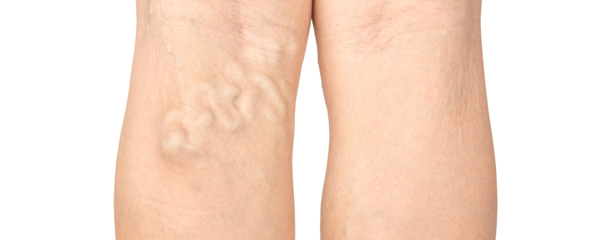 Treatment for Varicose Veins Columbia