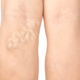 Treatment for Varicose Veins Columbia