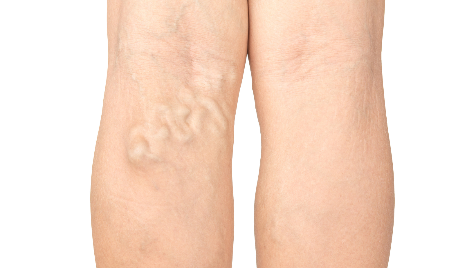 Treatment for Varicose Veins Columbia