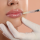 Guide to Lip Filler Maryland
