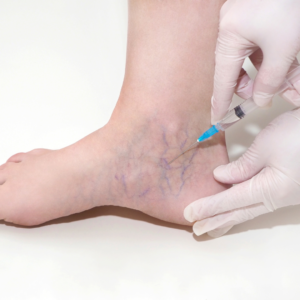 sclerotherapy cost Maryland