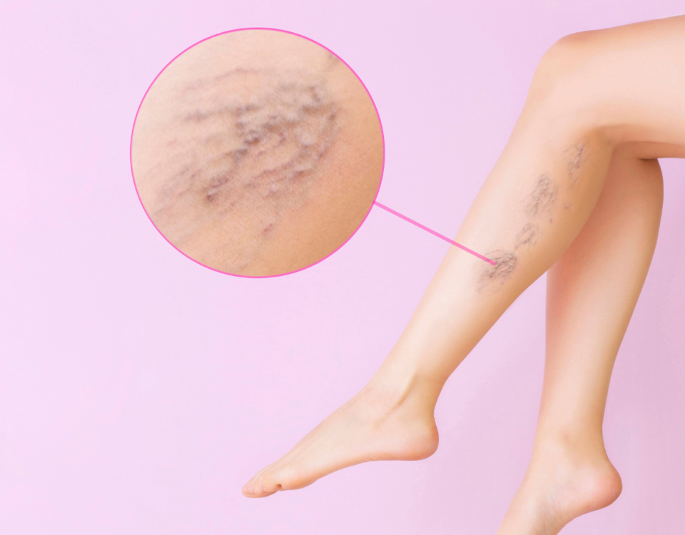 How to Get Rid of Varicose Veins