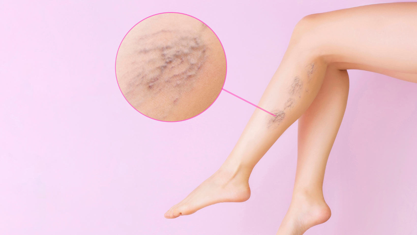 How to Get Rid of Varicose Veins