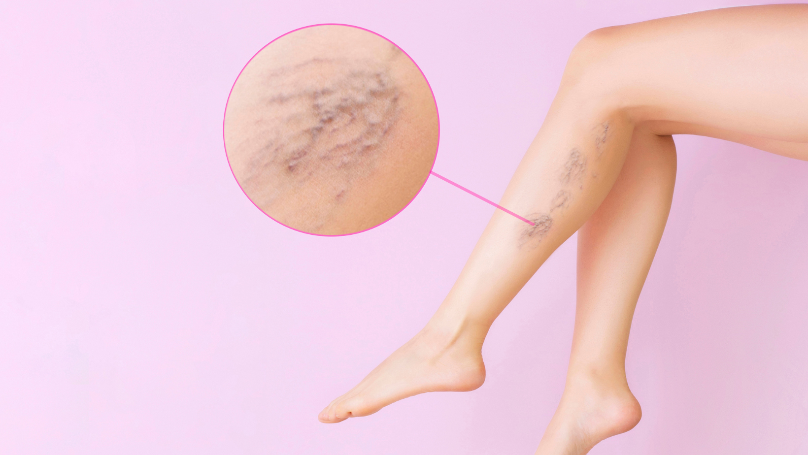 10 Myths About Varicose Veins - Modern Heart and Vascular