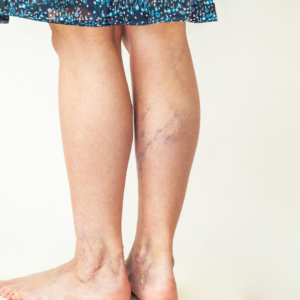 what causes spider veins