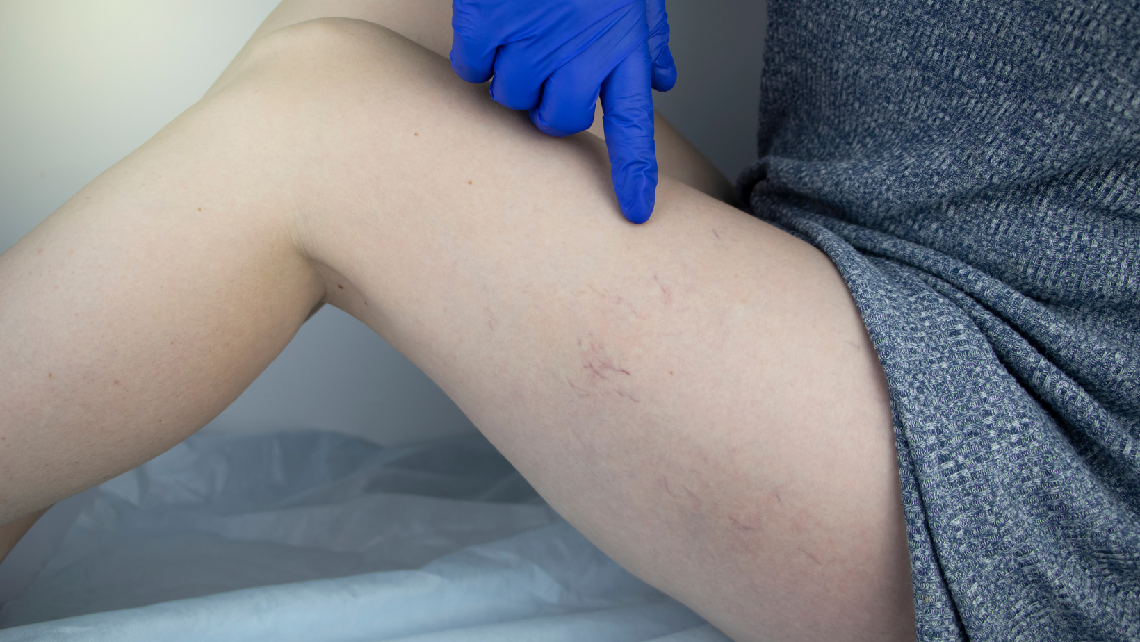 Sclerotherapy Cost in Maryland