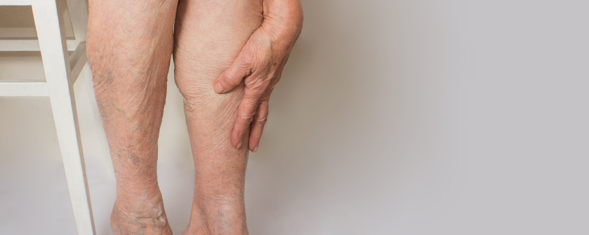 Are My Swollen Legs Caused by Varicose Veins