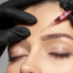 How Much Does Botox Cost in Westminster?