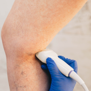 Does Insurance Cover Laser Vein Treatment