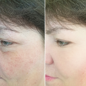 laser treatment for redness