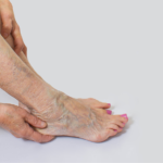 Vein Doctor for Sclerotherapy Columbia