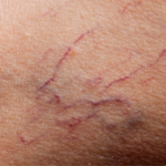 Treatment for Spider Veins Westminster