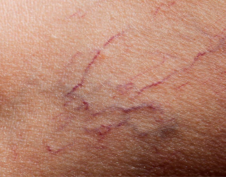 Treatment for Spider Veins Westminster