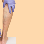 How Much Does Varicose Vein Treatment Cost Without Insurance?