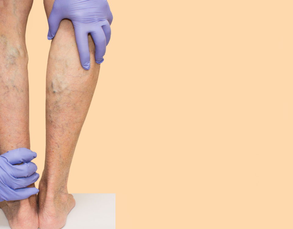 How Much Does Varicose Vein Treatment Cost Without Insurance?