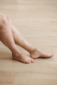 myths about varicose veins