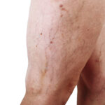 Laser Vein Treatment for Broken Capillaries in Bel Air