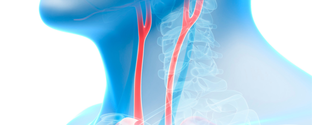 Doctor for Carotid Artery Disease in Maryland