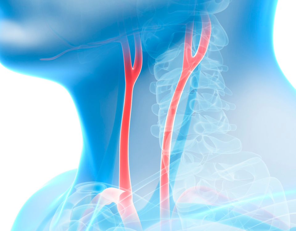 Doctor for Carotid Artery Disease in Maryland