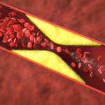 Understanding Atherosclerosis Symptoms and Treatment