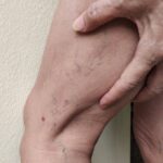 Q&A With the Best Itchy Vein Doctor in Bel Air Maryland