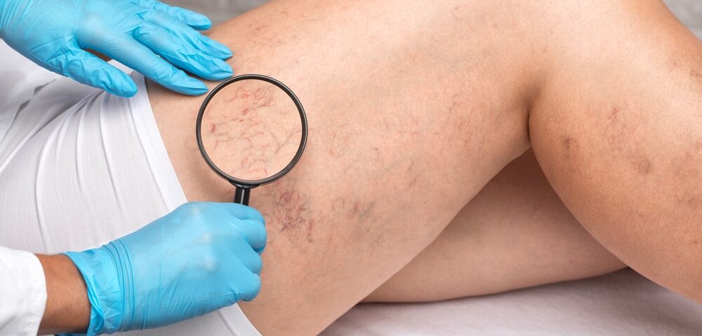 7 Signs to See a Vein Pain Specialist Near Aberdeen 