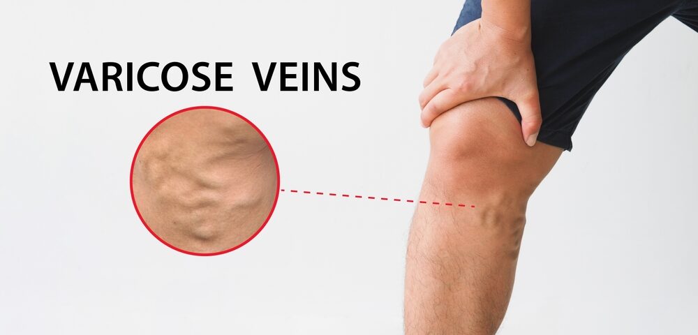 3 Top Treatments a Varicose Vein Specialist in Pikesville, Maryland Offers